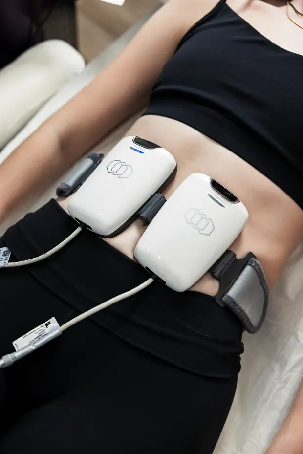 EmpowerRF body applicators positioned during a treatment